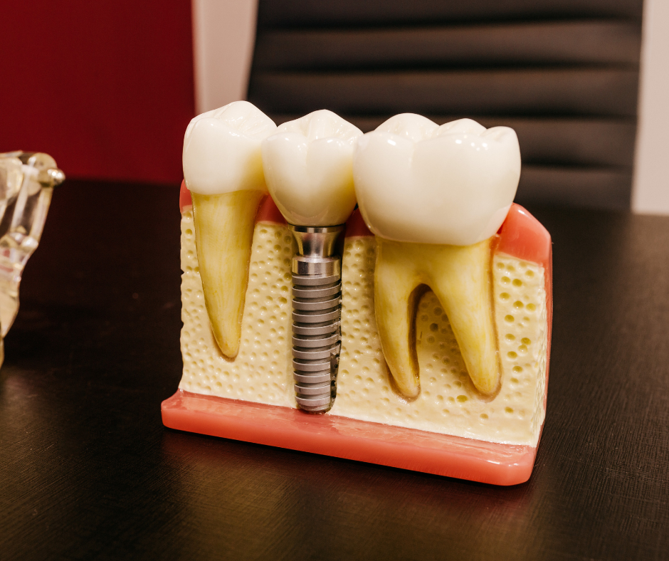 Searching for Dental Implants in Cranbourne? Here’s Everything You Need to Know