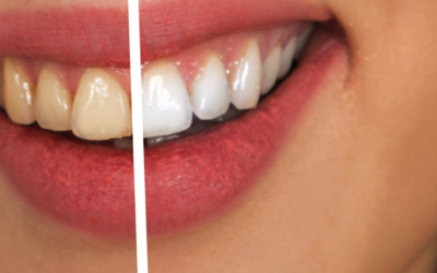 The Science Behind Teeth Whitening Carrum Downs and Why Professional Care Delivers Better Results