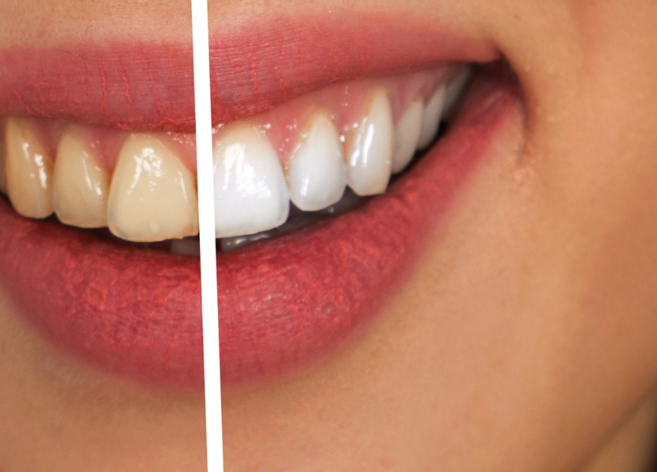 The Science Behind Teeth Whitening Carrum Downs and Why Professional Care Delivers Better Results