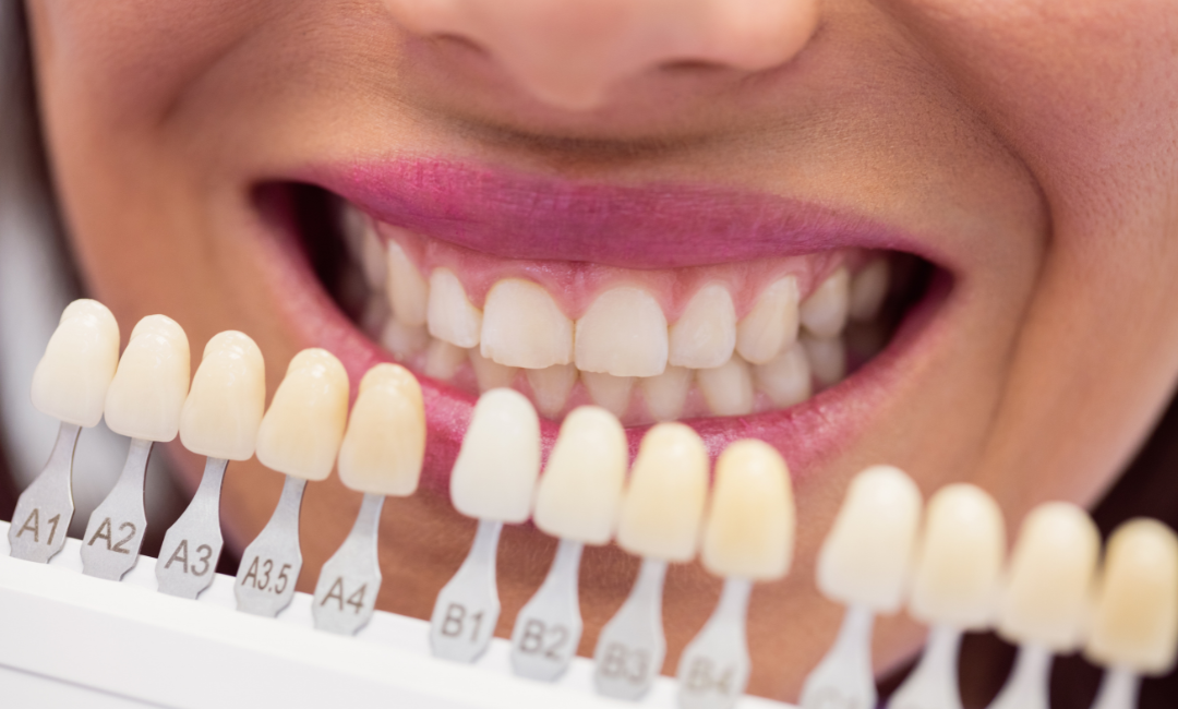 full set of veneers Penrith